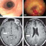 High seropositivity of IgG and IgM antibodies against cytomegalovirus (CMV) among HIV-1 seropositive...