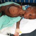 Monitoring the severity of iodine deficiency disorders in Uganda