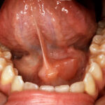 Salivary gland tumors in Uganda: clinical pathological study