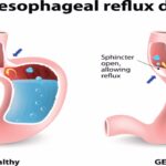gastroesophageal reflux disease